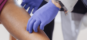 Varicose and spider veins: A warning sign?